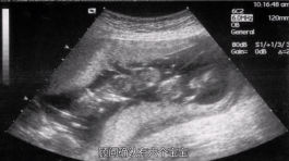 想要“一次懷倆”？多胎妊娠的后果你考慮清楚了嗎？